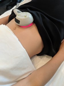 fertility-laser-treatment-toronto
